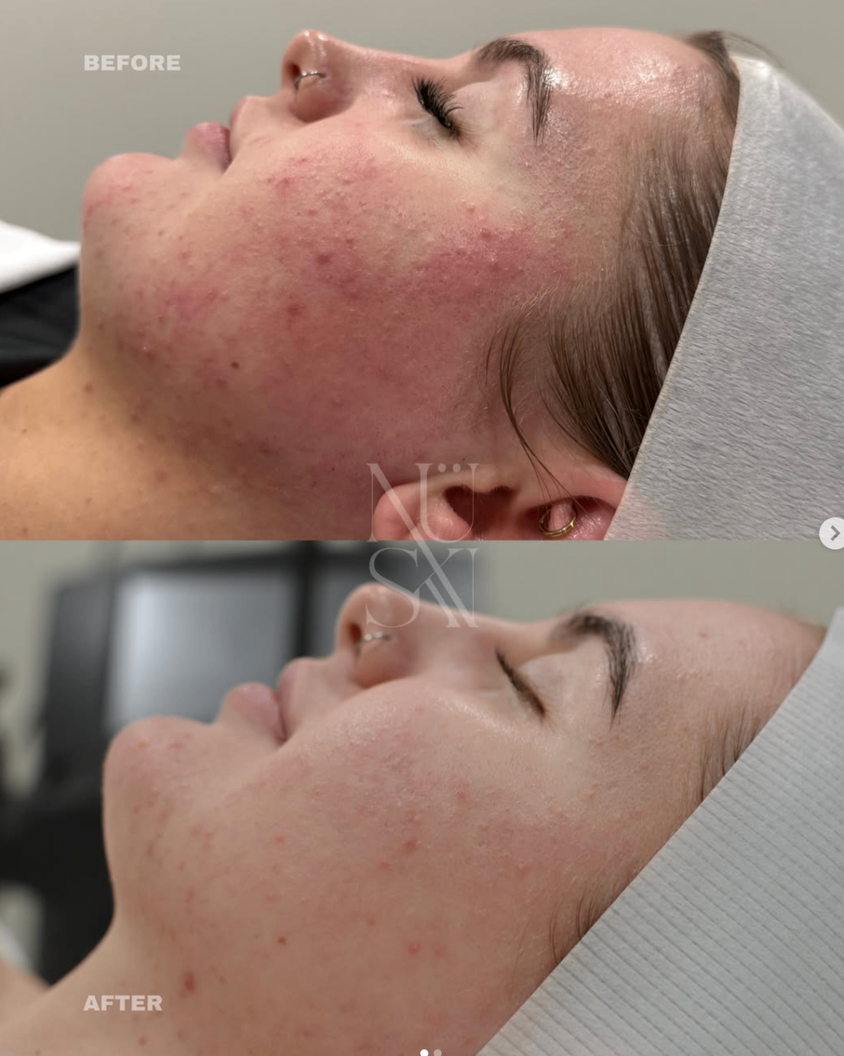 Before and after — NÜSKN client