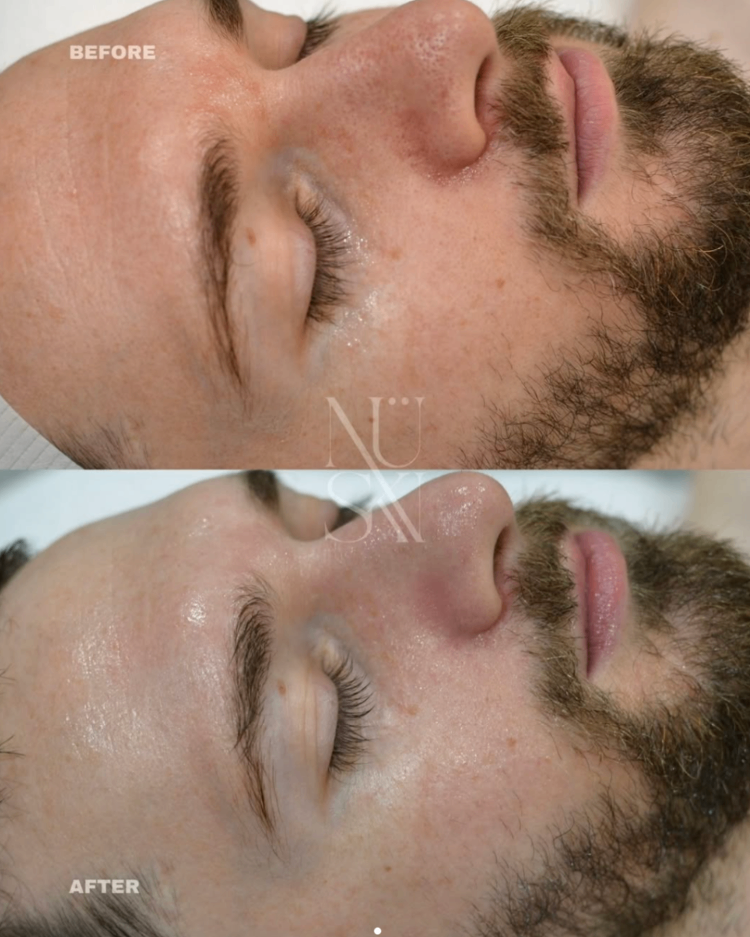 Before and after — NÜSKN client