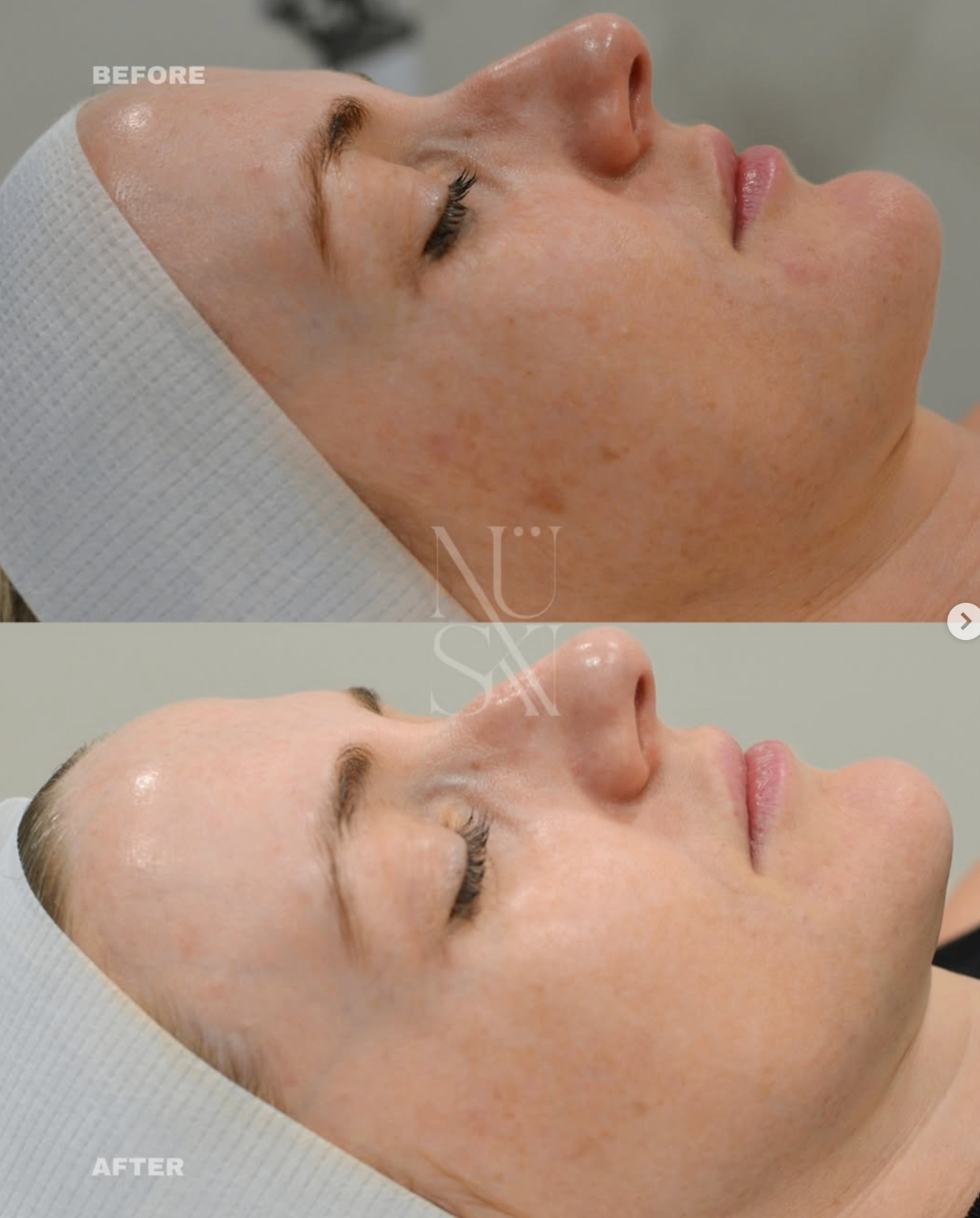 Before and after — NÜSKN client