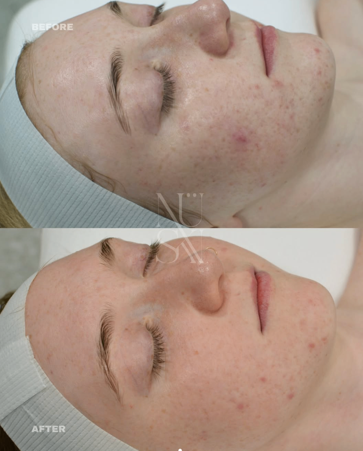 Before and after — NÜSKN client