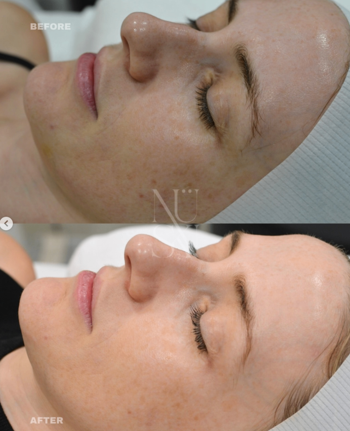 Before and after — NÜSKN client